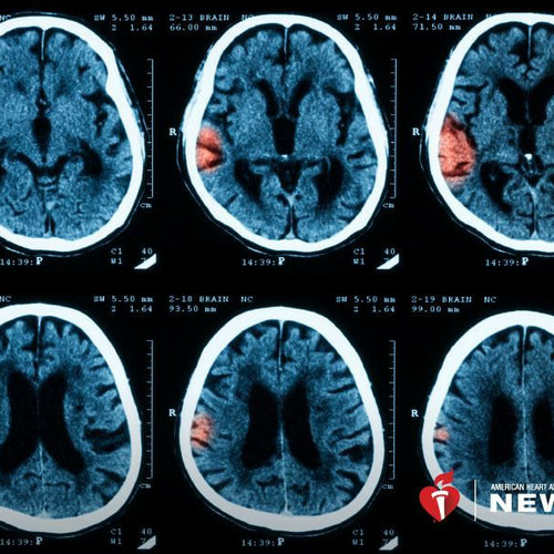 Genetic risk of stroke? A healthy lifestyle can help